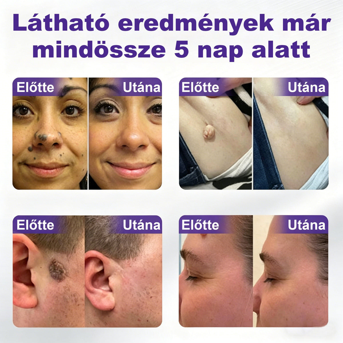 CleraNaure® mikrotűs szemölcs- és anyajegyeltávolító tapasz🎁