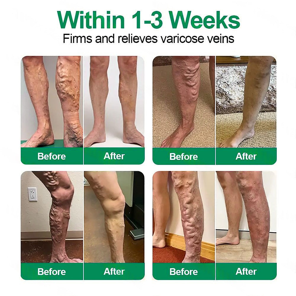 👨‍⚕️🦵✅Healrize® VeinTarget mikrotűs tapasz ⚡Azonnali enyhülés hosszú távú eredmények