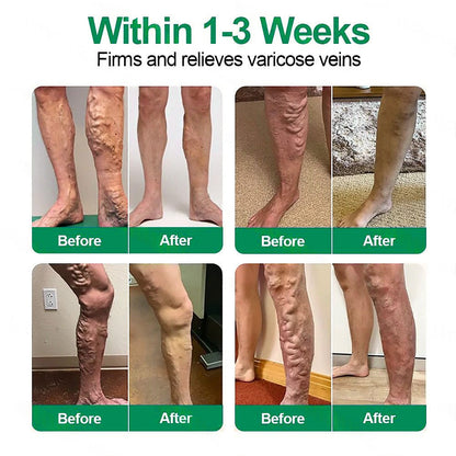 👨‍⚕️🦵✅Healrize® VeinTarget mikrotűs tapasz ⚡Azonnali enyhülés hosszú távú eredmények