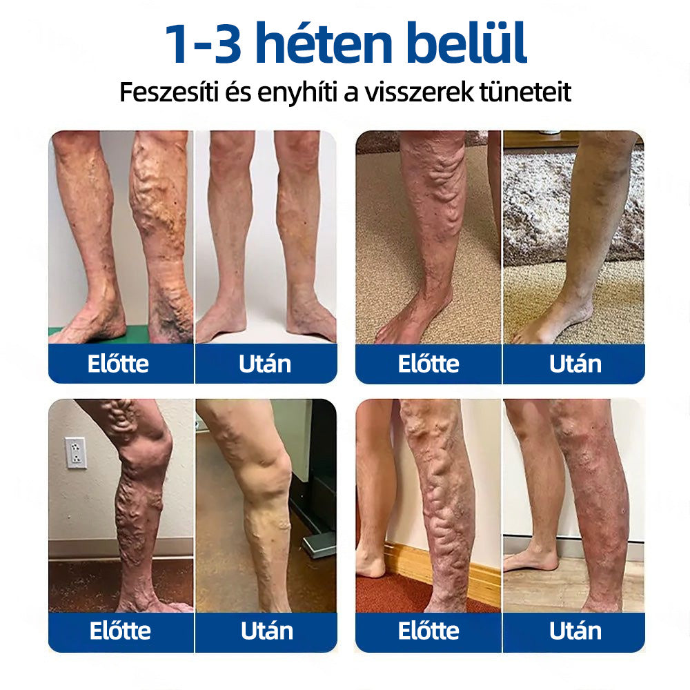 🇭🇺𝐇𝐞𝐚𝐥𝐫𝐢𝐳𝐞® 👩‍⚕️VeinTarget mikrotűs tapasz⚡☑️Azonnali enyhülés hosszú távú eredmények📦