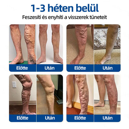 🇭🇺𝐇𝐞𝐚𝐥𝐫𝐢𝐳𝐞® 👩‍⚕️VeinTarget mikrotűs tapasz⚡☑️Azonnali enyhülés hosszú távú eredmények📦