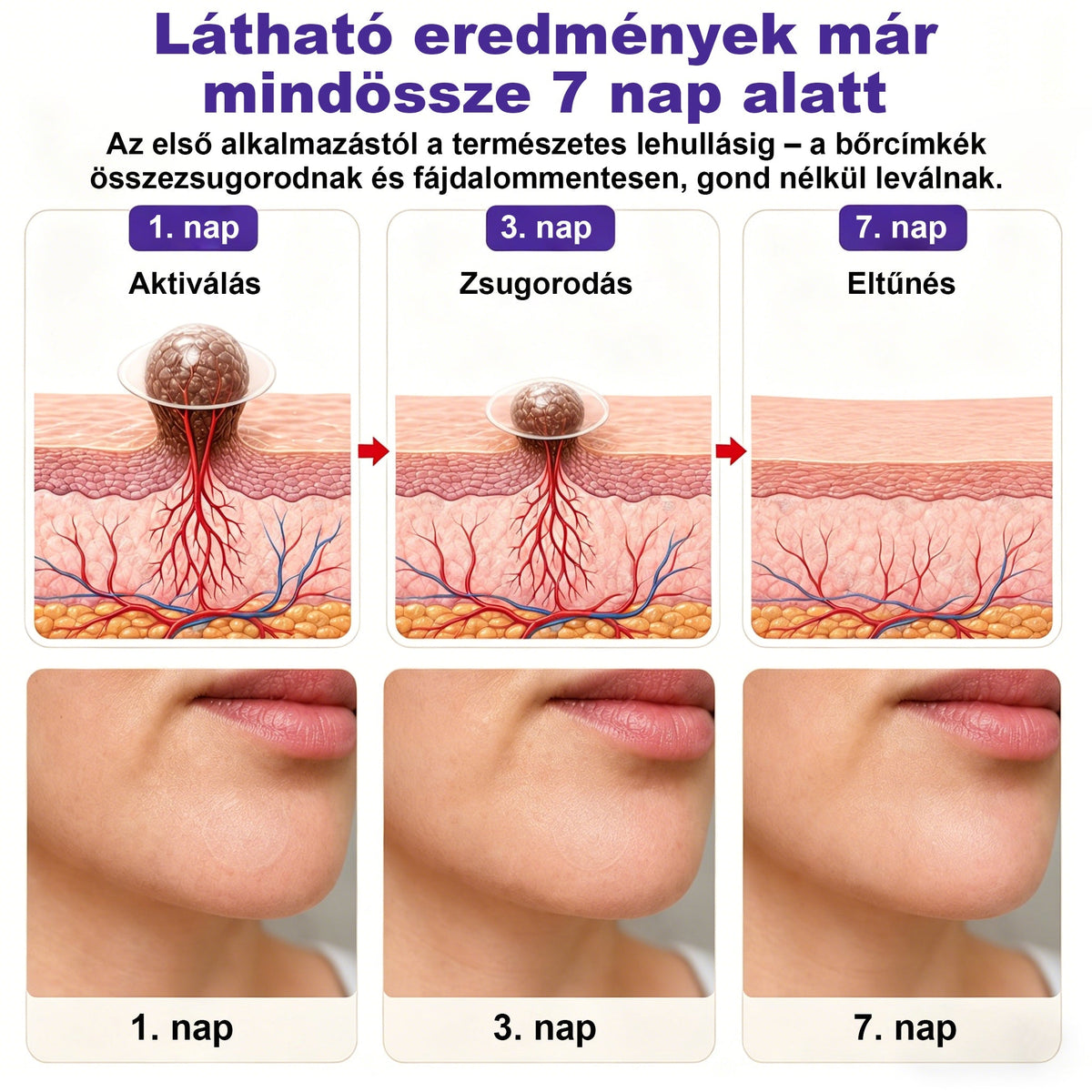 CleraNaure® mikrotűs szemölcs- és anyajegyeltávolító tapasz🎁