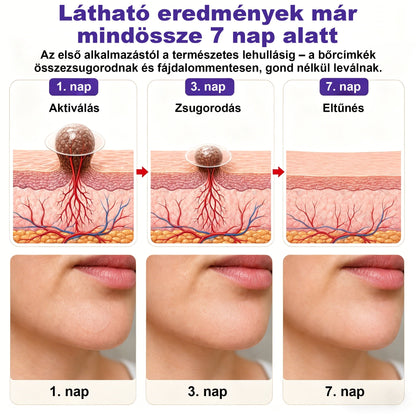 CleraNaure® mikrotűs szemölcs- és anyajegyeltávolító tapasz🎁